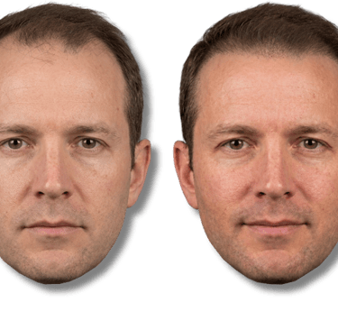 Before and after SMP results showing improved hairline density for men.
