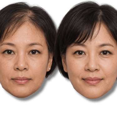 Before and after SMP treatment results for a woman showing increased hair density.