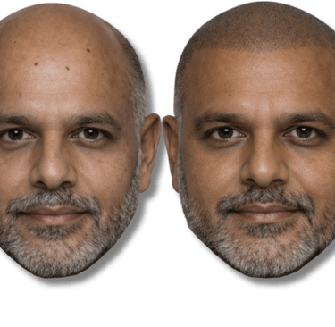 Before and after comparison of scalp micropigmentation for male pattern baldness treatment.