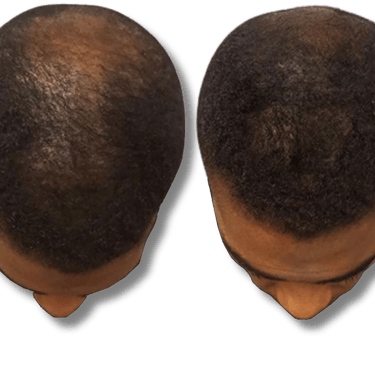 Before and after results of hair restoration showing increased hair density and regrowth on the crown.