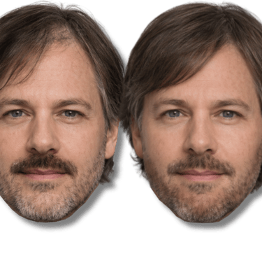 Before and after comparison of hair SMP on a man with a beard.