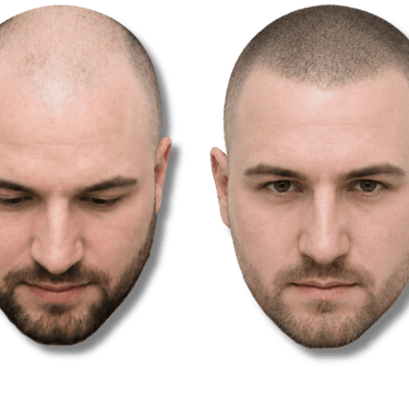 Before and after comparison of scalp micropigmentation for male pattern baldness and hair thinning.