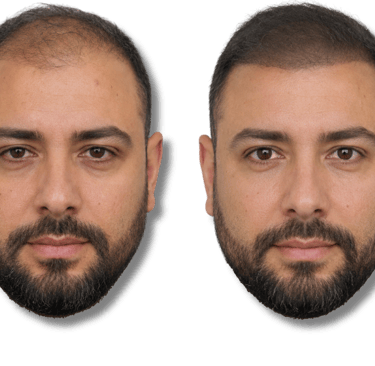Before and after SMP results showing a man with restored hairline and increased hair density.