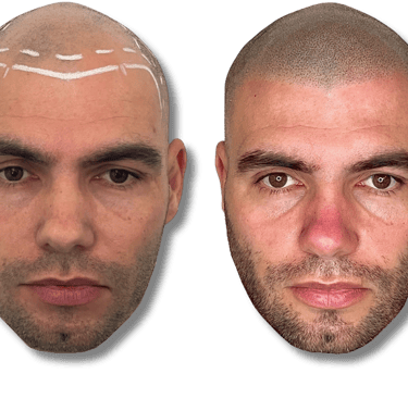 Before and after scalp micropigmentation showing a bald man's natural-looking hairline restoration.