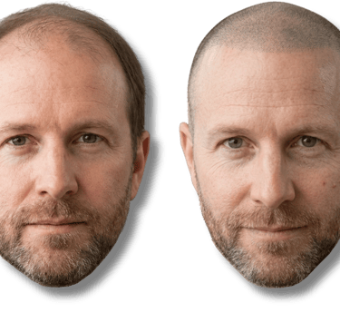 Before and after scalp micropigmentation results showing a man with hair loss restored with a buzzed look.