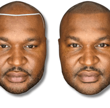 Before and after scalp micropigmentation for hair loss showing a restored hairline on a bald man.