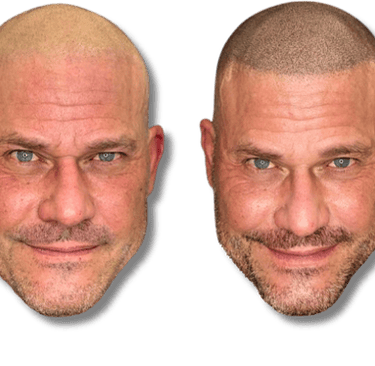 Before and after scalp micropigmentation treatment for a natural looking hairline on a bald man.