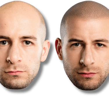 Before and after scalp micropigmentation results for male pattern baldness and hair density.