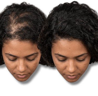 Before and after comparison of a woman's scalp showing effective SMP treatment.