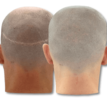 Before and after scalp micropigmentation results concealing a linear hair transplant scar.