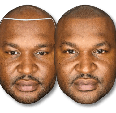 Before and after results of scalp micropigmentation for a natural-looking hairline on a bald man.