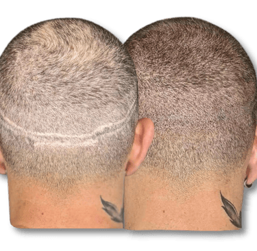 Scalp micropigmentation before and after results concealing a linear hair transplant scar.