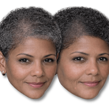 Before-and-after of a man's scalp micropigmentation, showing a fuller, denser hair look for hair loss solutions.