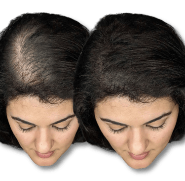 Before and after comparison of female hair thinning treatment showing increased scalp coverage.