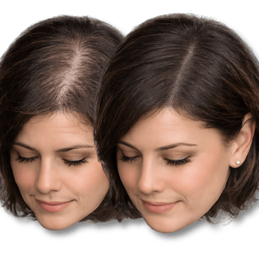 Before and after comparison of female hair thinning treatment showing improved scalp coverage.