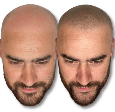 Before and after scalp micropigmentation results showing a realistic hair tattoo hairline for male pattern baldness.
