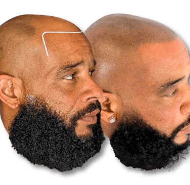 Before and after scalp micropigmentation results for a man with a beard to restore a natural hairline.