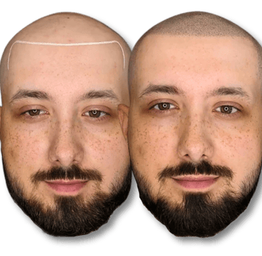 Before and after scalp micropigmentation results for a man with a bald head and beard.