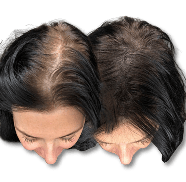 Before and after comparison of female hair thinning and restoration results for scalp regrowth.