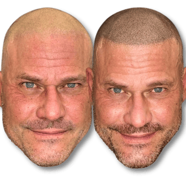 Before and after scalp micropigmentation results showing a realistic hair tattoo hairline on a bald man.