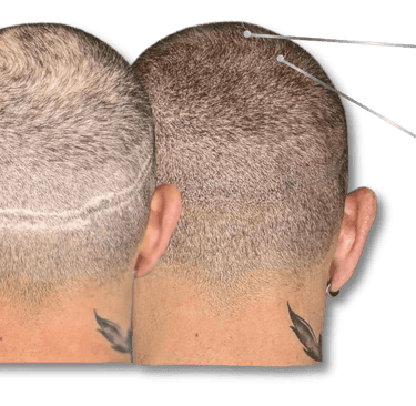 Before and after scalp micropigmentation showing effective hair transplant scar camouflage.
