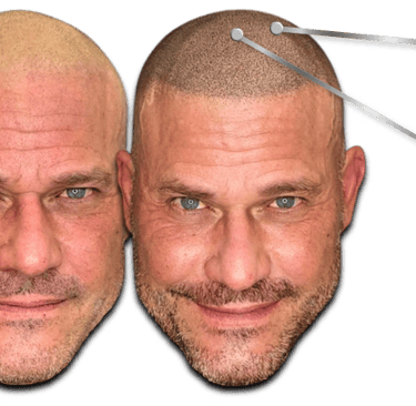 Before and after comparison of scalp micropigmentation for male hair loss restoration.