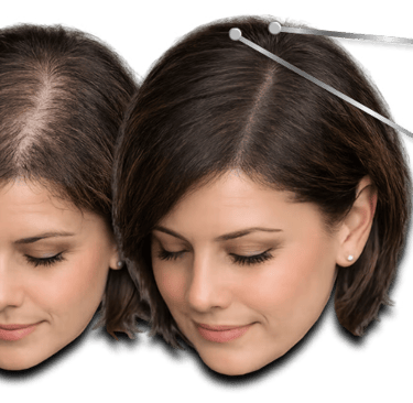 Before and after comparison of a woman's thinning hair showing successful hair regrowth treatment results.