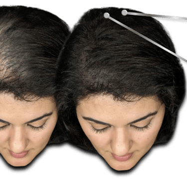 Before and after comparison of a woman's scalp showing effective hair loss treatment and regrowth.