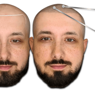 Before and after scalp micropigmentation showing a bald head restored with a natural hairline tattoo.