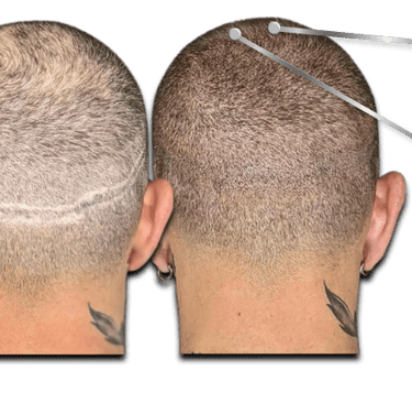 Before and after scalp micropigmentation to camouflage an FUT hair transplant scar on the back of the head.