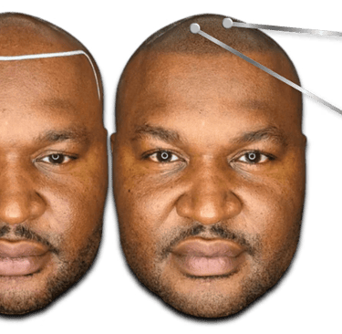 Before and after scalp micropigmentation showing a restored hairline for male pattern baldness.