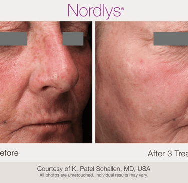 before and after acne scar treatment results at Texture & Tone Skin Studio in Hamilton