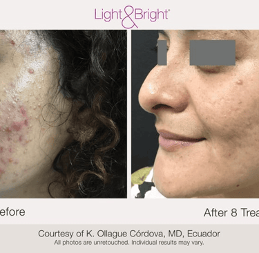 before and after acne scar improvement after treatment at Texture & Tone Skin Studio in Hamilton