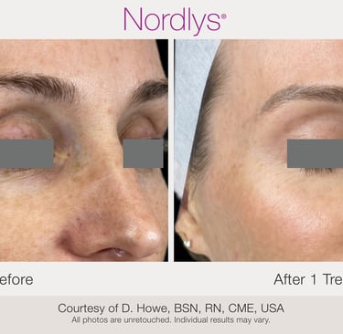 before and after skin texture improvement and rejuvenation results in Hamilton Ontario