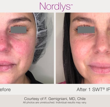 Redness & Vascular (Rosacea) Treatment in Hamilton, Ontario