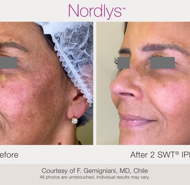 acne treatment before and after results in Hamilton skin clinic