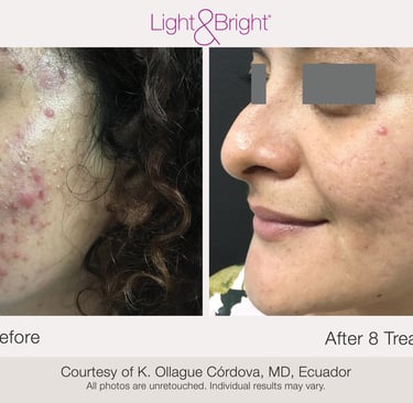 acne and scar treatment results in Hamilton clinic