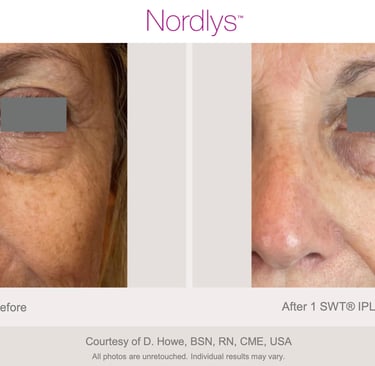 professional acne treatment improving skin texture and clarity in Hamilton
