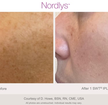 before and after stretch mark and skin texture improvement results in Hamilton clinic