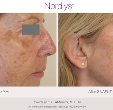 advanced pigmentation removal treatment for clearer skin in Hamilton Ontario