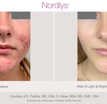 skin improvement after acne scar treatment at Hamilton skincare clinic