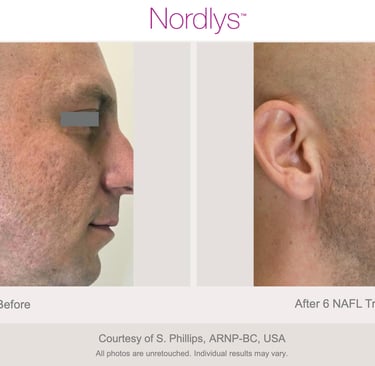 before and after acne scar improvement results at Hamilton skincare clinic