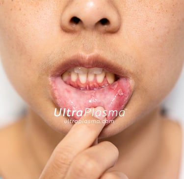 ultraplasma.com_aphthous-ulcer-or-canker-sore_treatment_ultra_plasma_ultra_plazma_ultra_plasma_ultra