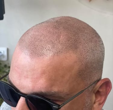 homme tatouage cheveux micropigmentation capillaire chauve