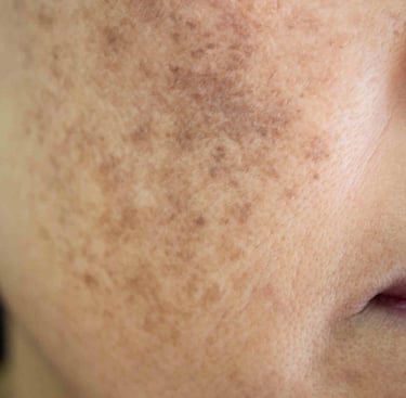 melasma face