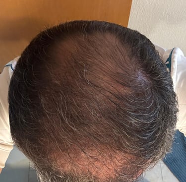Progreso de 2 meses usando AUREVIA™