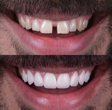 best cosmetic dentist in sanpada navi mumbai, smile makeover, bollywood smile, best dentist in nerul