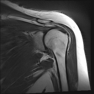 Shoulder MRI