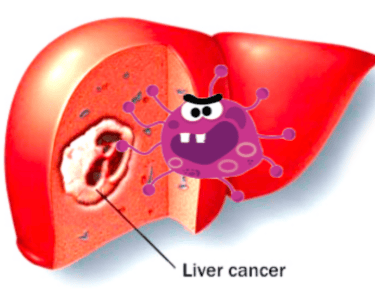 Liver tumour in picture