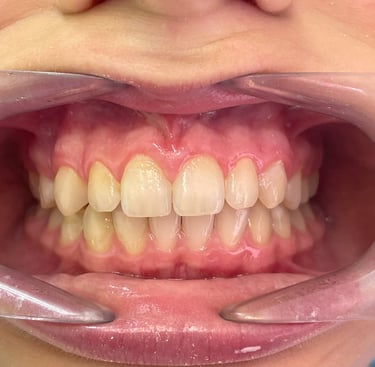 Proste zęby po leczeniu ortodontycznym